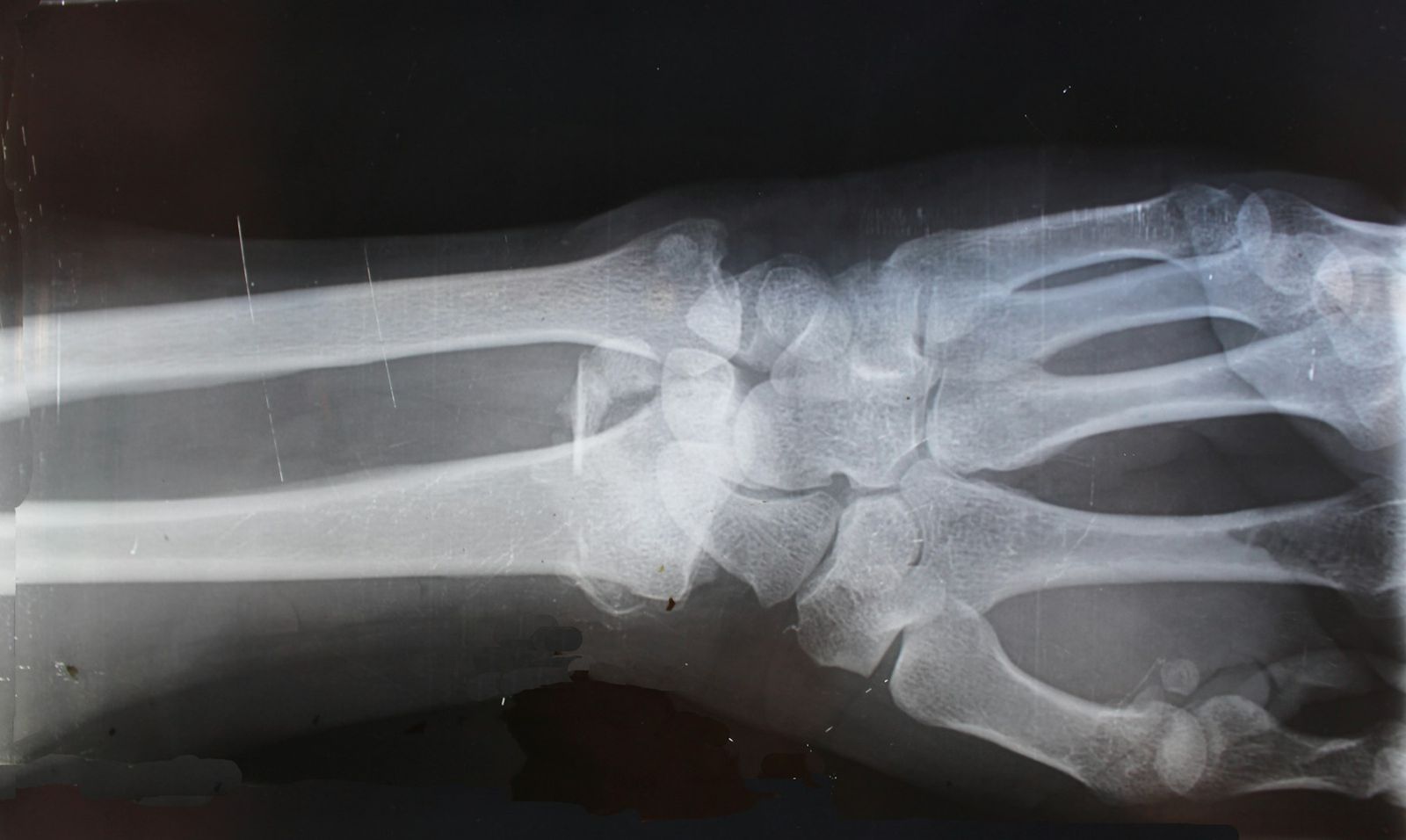 An X-ray of the wrist and forearm bones